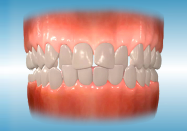 crowded lower front teeth
